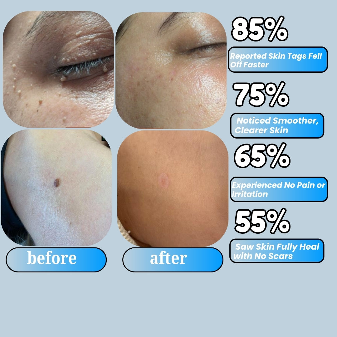 DermaTag Removal Kit