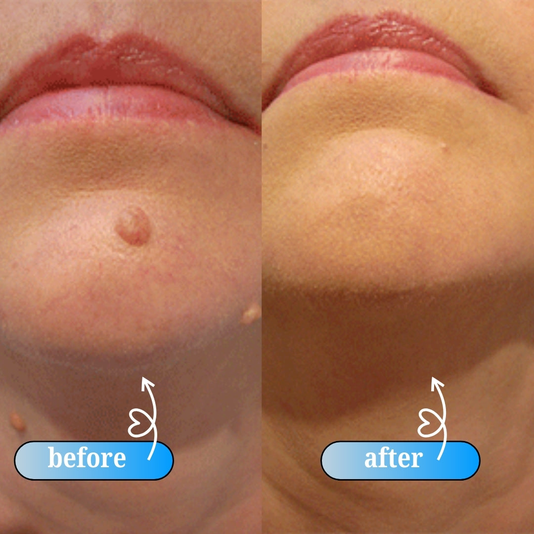 DermaTag Removal Kit