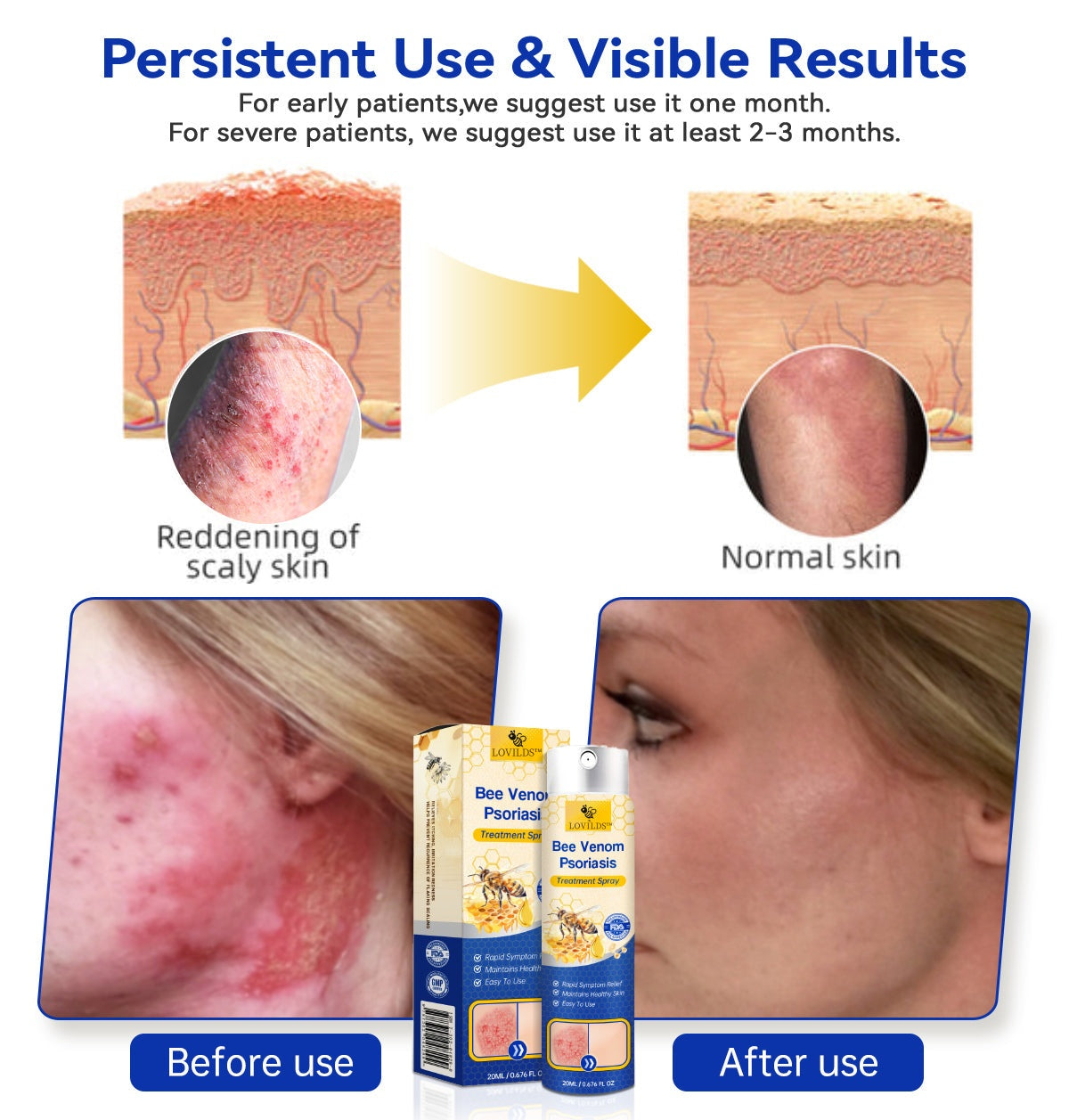 🔥LOVILDS™PsoriaHeal psoriasis Spray pro(🔥 60% off bundle purchase last day limited 🔥)