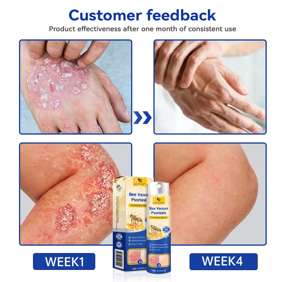 🔥LOVILDS™PsoriaHeal psoriasis Spray pro(🔥 60% off bundle purchase last day limited 🔥)