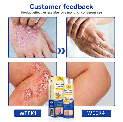 🔥LOVILDS™PsoriaHeal psoriasis Spray pro(🔥 60% off bundle purchase last day limited 🔥)