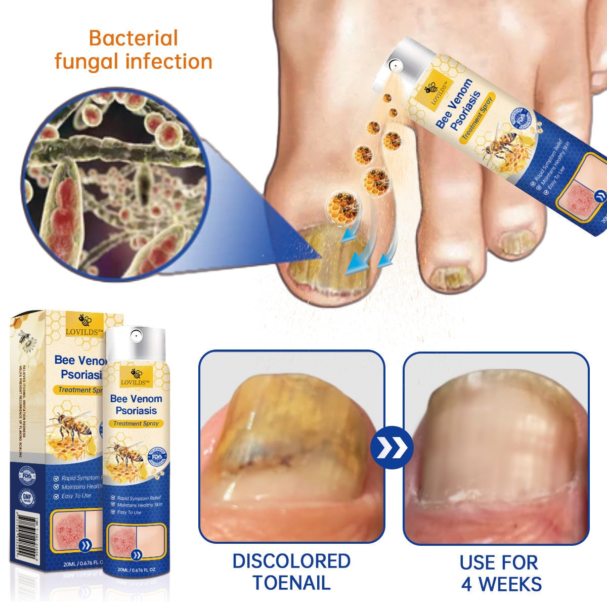 🔥LOVILDS™PsoriaHeal psoriasis Spray pro(🔥 60% off bundle purchase last day limited 🔥)