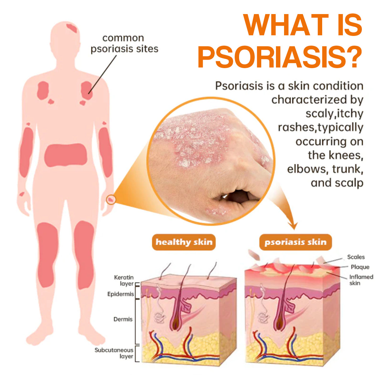 🔥LOVILDS™PsoriaHeal psoriasis Spray pro(🔥 60% off bundle purchase last day limited 🔥)