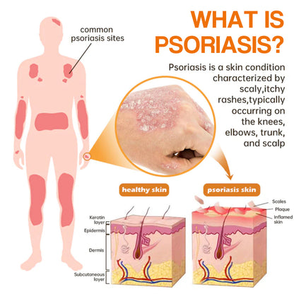 🔥LOVILDS™PsoriaHeal psoriasis Spray pro(🔥 60% off bundle purchase last day limited 🔥)
