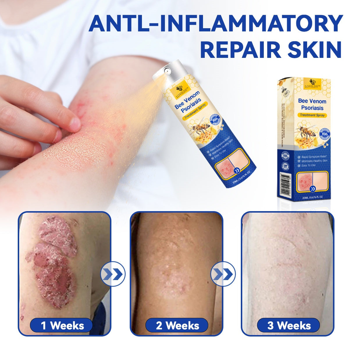 🔥LOVILDS™PsoriaHeal psoriasis Spray pro(🔥 60% off bundle purchase last day limited 🔥)