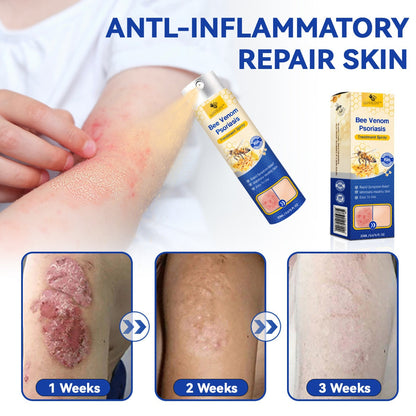 🔥LOVILDS™PsoriaHeal psoriasis Spray pro(🔥 60% off bundle purchase last day limited 🔥)