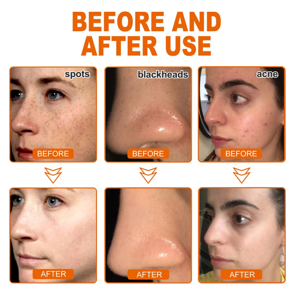 🔥[Official Brand Store] AQA™ Herbal Spots Peel-Off Facial Mask (✨BUY 2 GET 1 FREE🎁)