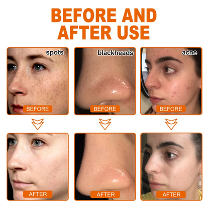 🔥[Official Brand Store] AQA™ Herbal Spots Peel-Off Facial Mask (✨BUY 2 GET 1 FREE🎁)