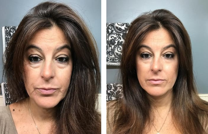 Hza Second Gen Instant Wrinkle Eraser 21 DM 20250319154235 001